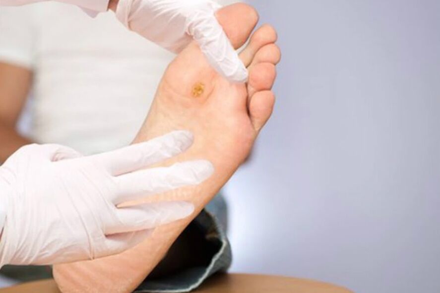 Diabetická noha - závažná komplikácia cukrovky